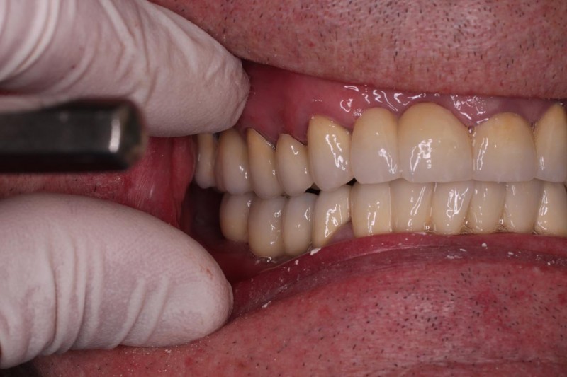 Komplexní náhrada chybějících zubů pomocí implantátů a můstků
