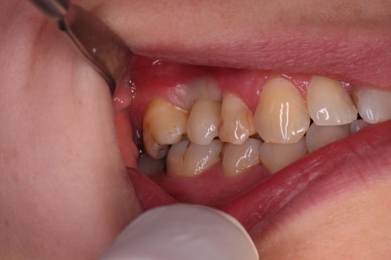 Náhrada postranního zubu implantátem