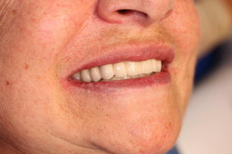Náhrada všech zubů v horní čelisti pomocí implantátů a kovokeramického můstku