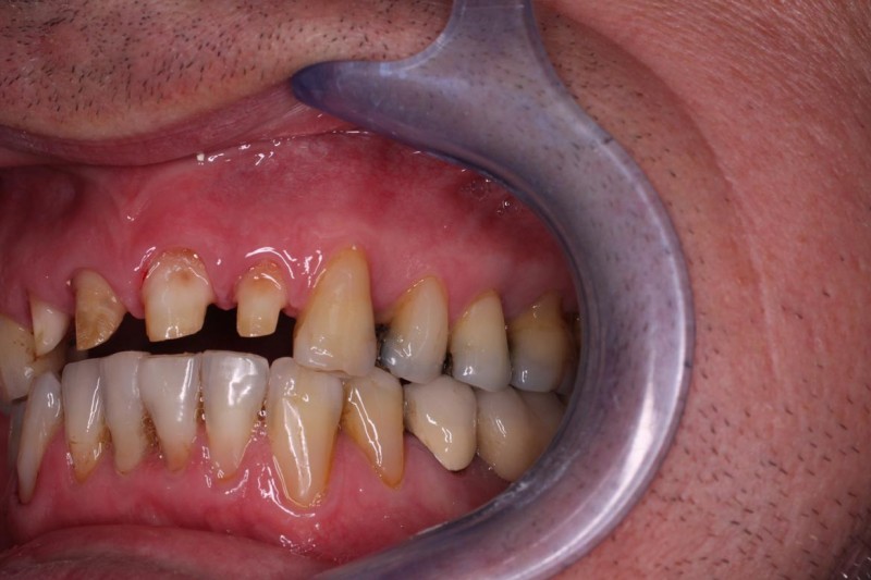 Sekce protetika - kombinace ošetření klínovitých defektů zubních krčků a keramické korunky  