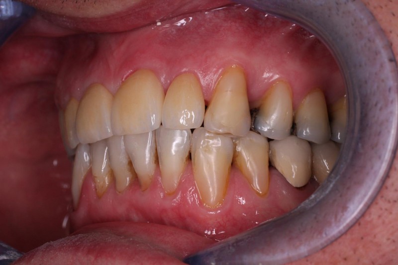 Sekce protetika - kombinace ošetření klínovitých defektů zubních krčků a keramické korunky  